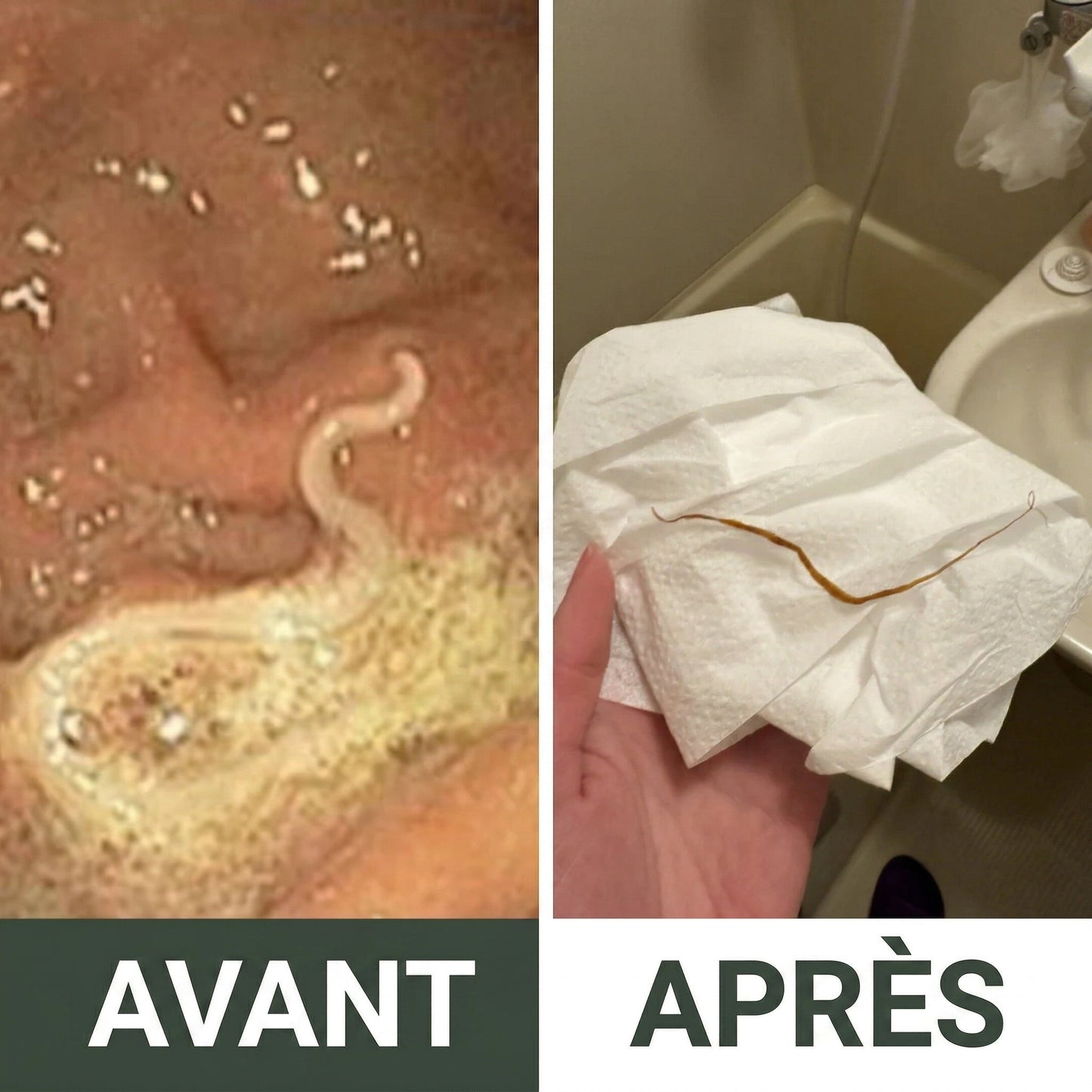 Avant / Après - ver expulsé
