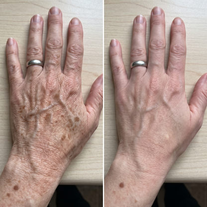 Avant et après sur les mains — protocole 8 semaines