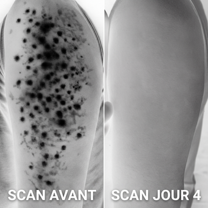 Scan avant / jour 4