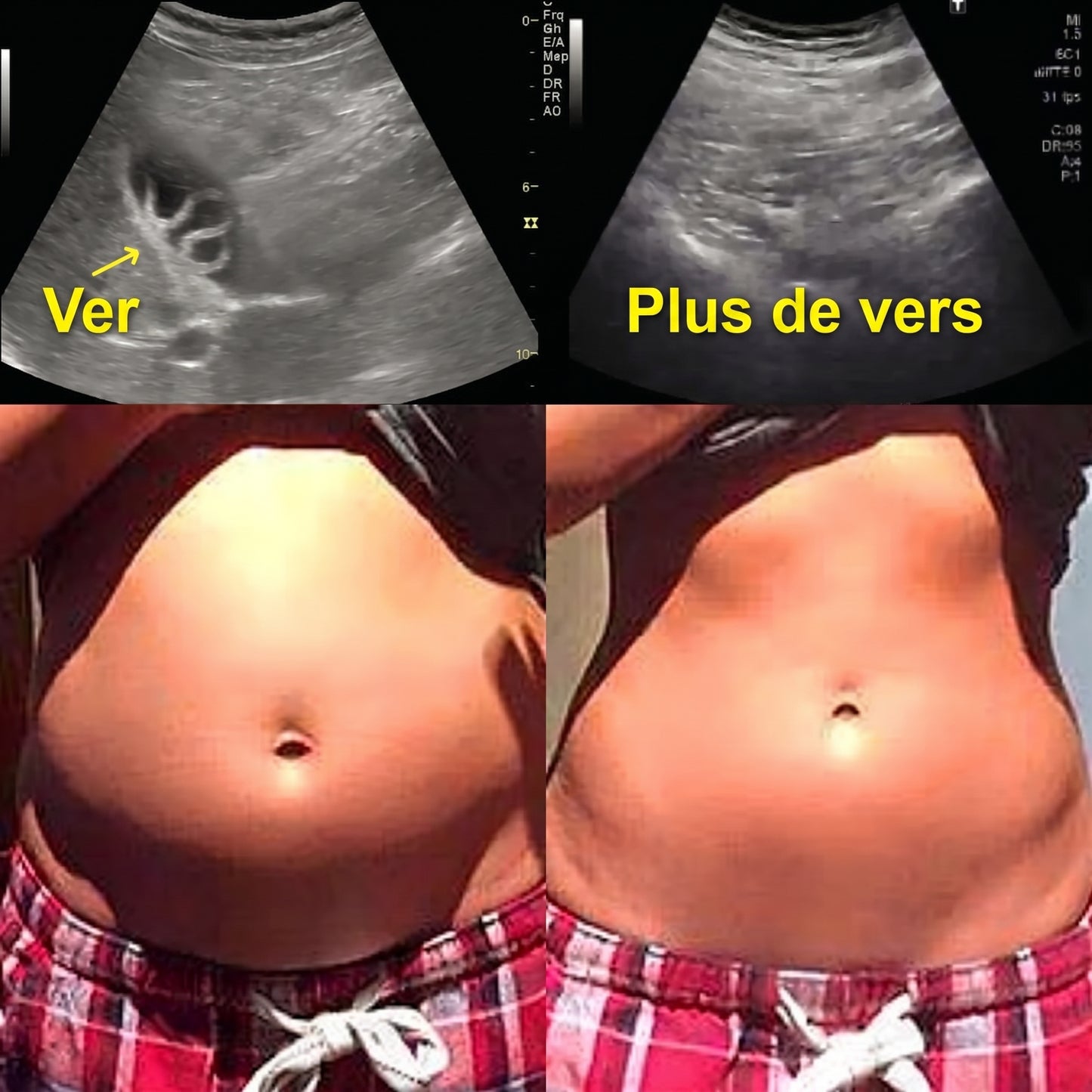 Échographie avant / après - plus de vers