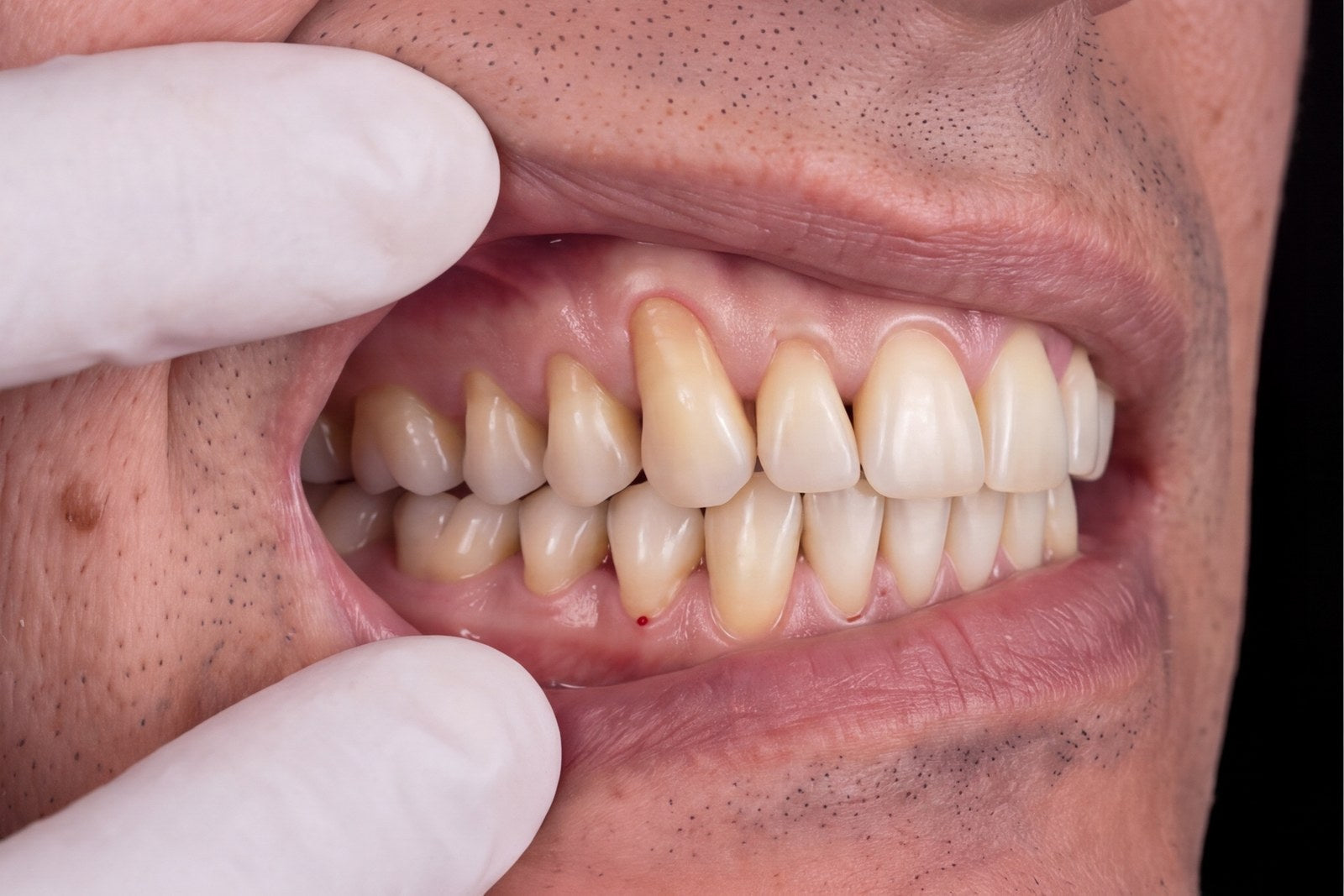Gum line at weeks 1 to 2